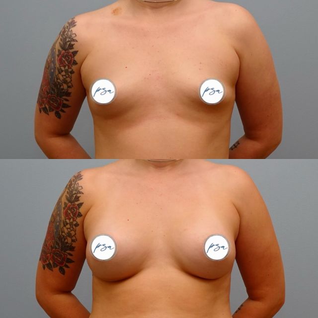 Breast augmentation with silicone implants ✨

This patient chose 330 cc implants for a natural yet enhanced look, achieving a balanced and confident result. 

Surgeon: Aaron Berhanu, MD

#breastaugmentation #plasticsurgery #alaska