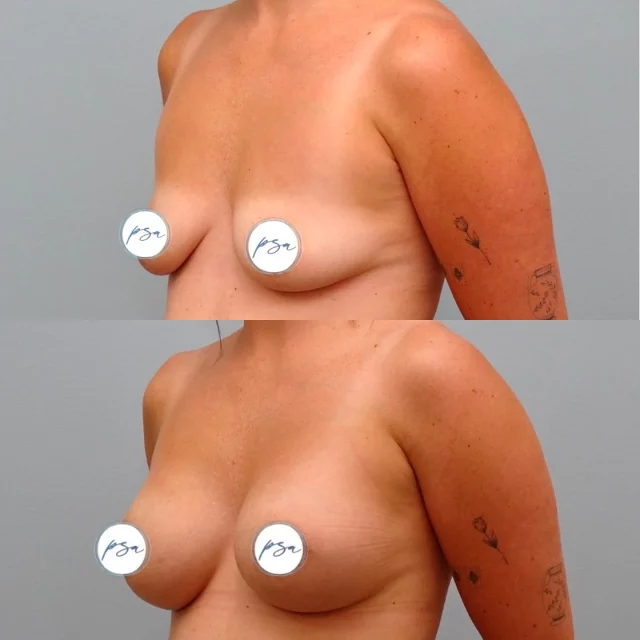 BAM 💥 

Breast Augmentation Mammoplasty 

This patient chose 300 cc gel implants 

Surgeon: James Lee, MD 

#breastaugementation #augmentationmammolasty #plasticsurgery #alaska